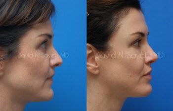 Chin Implant Before and After | Sayah Institute