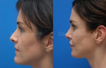 Chin Implant Before and After | Sayah Institute