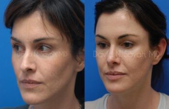 Chin Implant Before and After | Sayah Institute