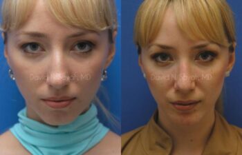 Rhinoplasty Before and After | Sayah Institute