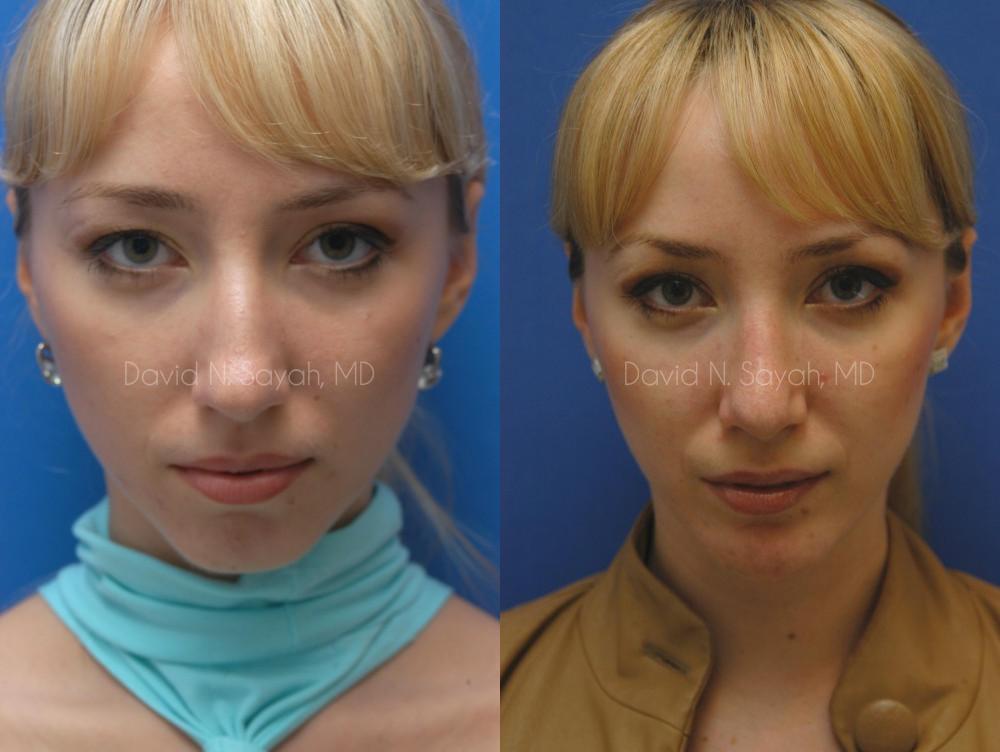 Rhinoplasty Before and After | Sayah Institute