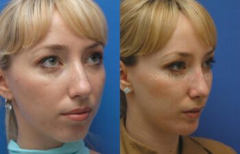 Rhinoplasty Before and After | Sayah Institute