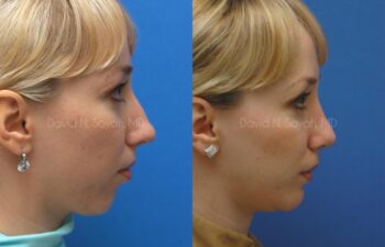 Rhinoplasty Before and After | Sayah Institute