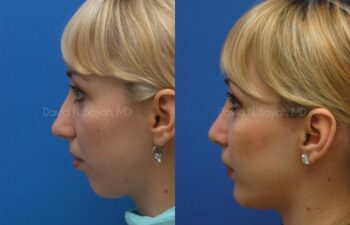 Rhinoplasty Before and After | Sayah Institute