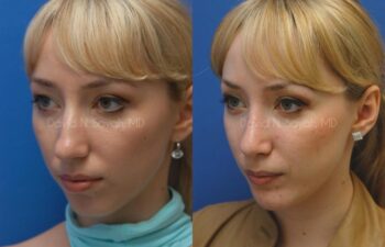 Rhinoplasty Before and After | Sayah Institute