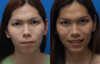 Chin Implant Before and After | Sayah Institute