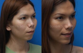 Chin Implant Before and After | Sayah Institute