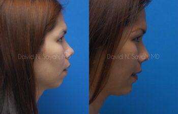 Chin Implant Before and After | Sayah Institute