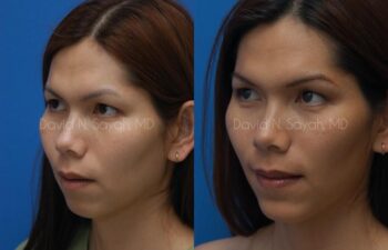 Chin Implant Before and After | Sayah Institute