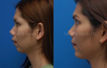 Chin Implant Before and After | Sayah Institute