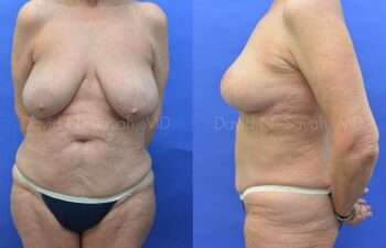 Breast Reduction Before and After | Sayah Institute