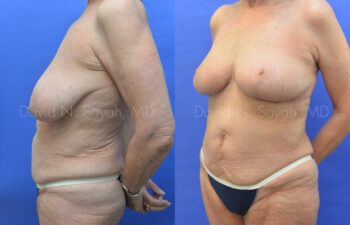 Breast Reduction Before and After | Sayah Institute