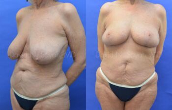 Breast Reduction Before and After | Sayah Institute