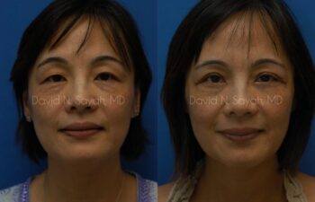 Eyelid Surgery Before and After | Sayah Institute