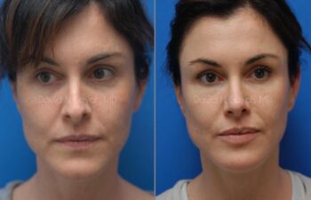Rhinoplasty Before and After | Sayah Institute