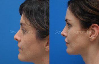Rhinoplasty Before and After | Sayah Institute