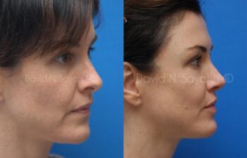 Rhinoplasty Before and After | Sayah Institute