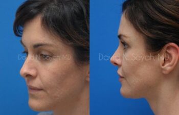 Rhinoplasty Before and After | Sayah Institute