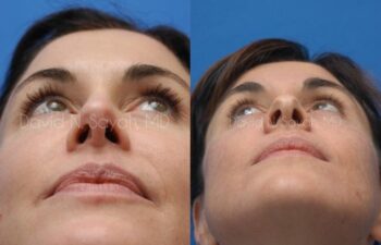 Rhinoplasty Before and After | Sayah Institute