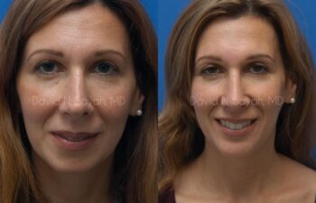 Rhinoplasty Before and After | Sayah Institute