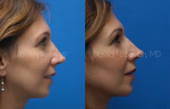 Rhinoplasty Before and After | Sayah Institute