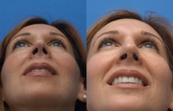 Rhinoplasty Before and After | Sayah Institute