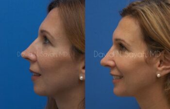 Rhinoplasty Before and After | Sayah Institute
