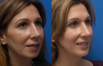 Rhinoplasty Before and After | Sayah Institute