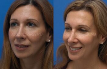 Rhinoplasty Before and After | Sayah Institute