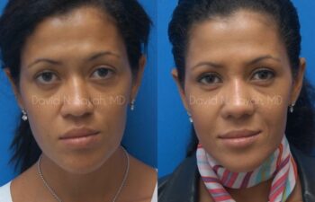 Rhinoplasty Before and After | Sayah Institute
