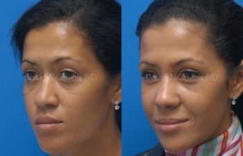 Rhinoplasty Before and After | Sayah Institute