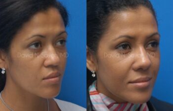 Rhinoplasty Before and After | Sayah Institute