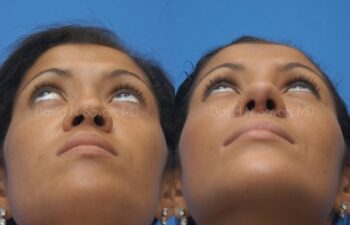 Rhinoplasty Before and After | Sayah Institute