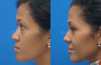 Rhinoplasty Before and After | Sayah Institute