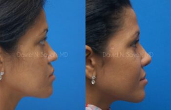 Rhinoplasty Before and After | Sayah Institute