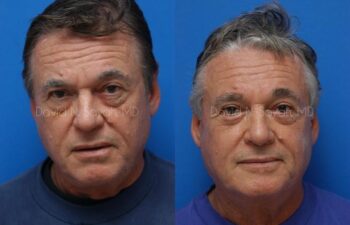 Eyelid Surgery Before and After | Sayah Institute