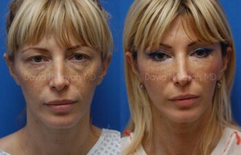 Eyelid Surgery Before and After | Sayah Institute