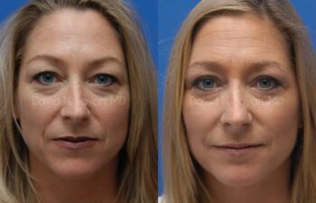 Eyelid Surgery Before and After | Sayah Institute