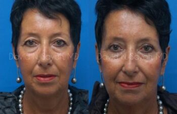 Eyelid Surgery Before and After | Sayah Institute
