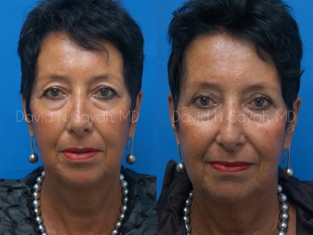 Eyelid Surgery Before and After | Sayah Institute