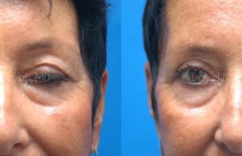 Eyelid Surgery Before and After | Sayah Institute
