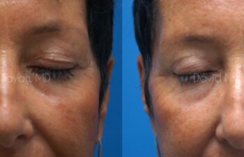 Eyelid Surgery Before and After | Sayah Institute
