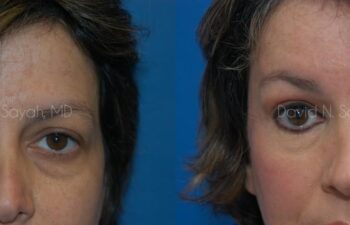 Endoscopic Brow Lift Before and After | Sayah Institute