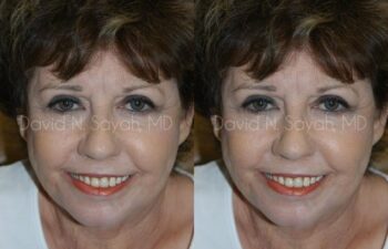 Endoscopic Brow Lift Before and After | Sayah Institute