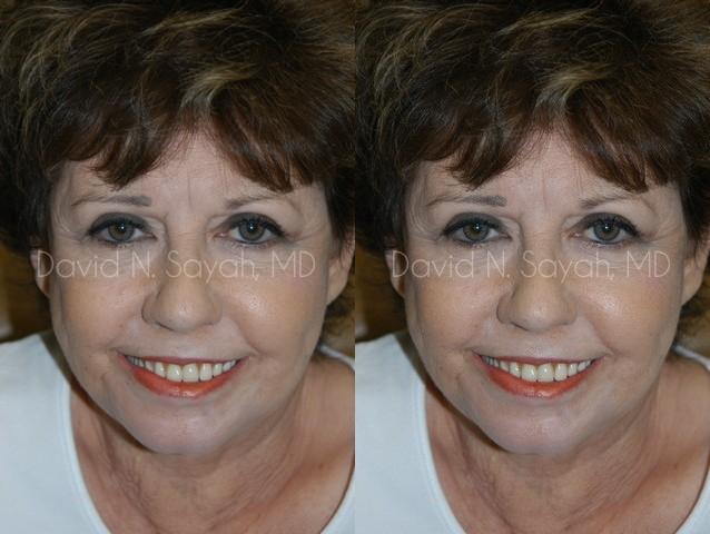 Endoscopic Brow Lift Before and After | Sayah Institute