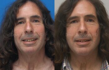 Neck Lift Before and After | Sayah Institute