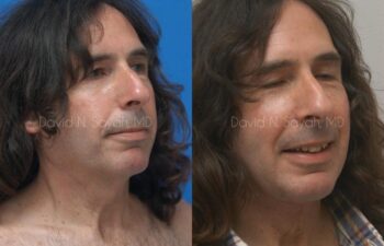 Neck Lift Before and After | Sayah Institute