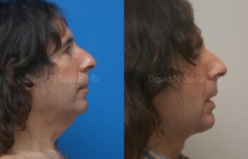 Neck Lift Before and After | Sayah Institute