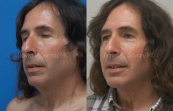 Neck Lift Before and After | Sayah Institute