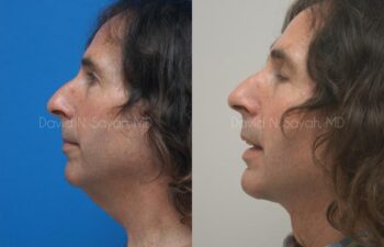 Neck Lift Before and After | Sayah Institute
